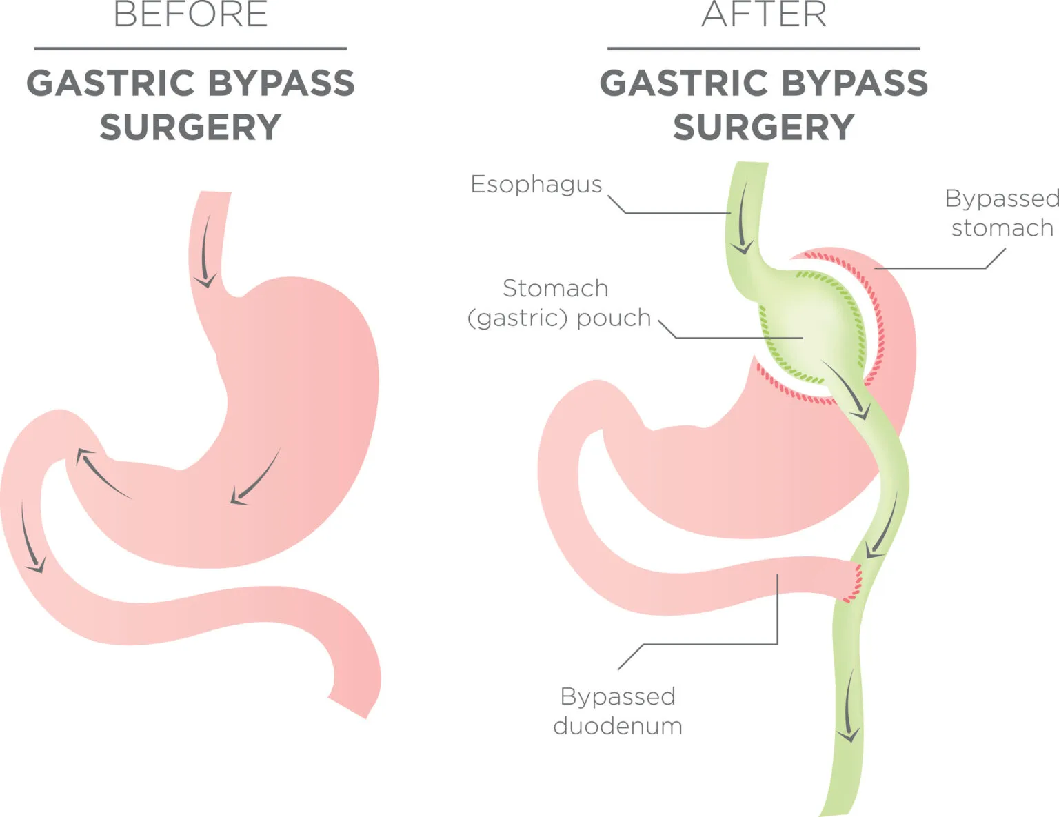 gastric