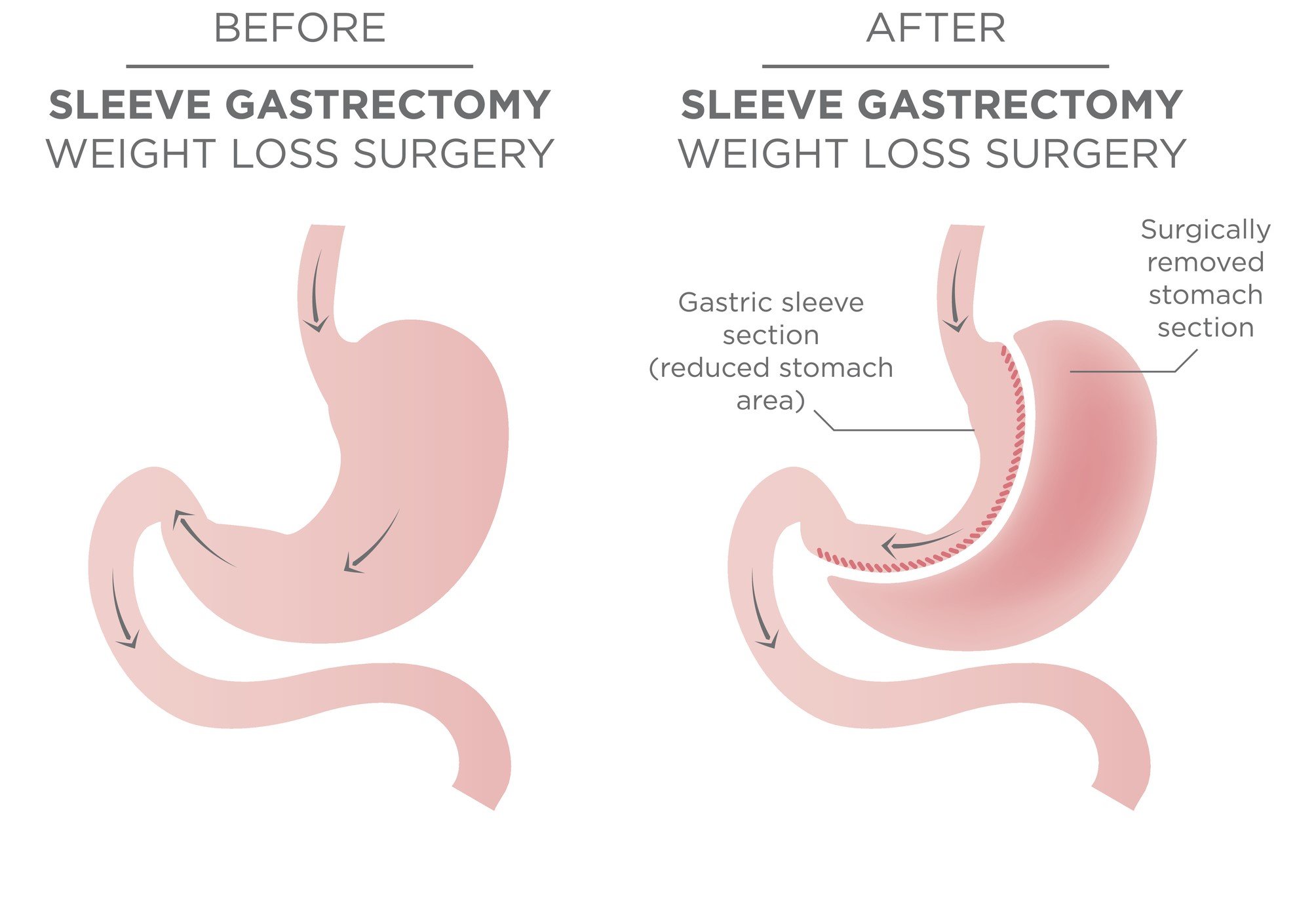 price of gastric sleeve surgery