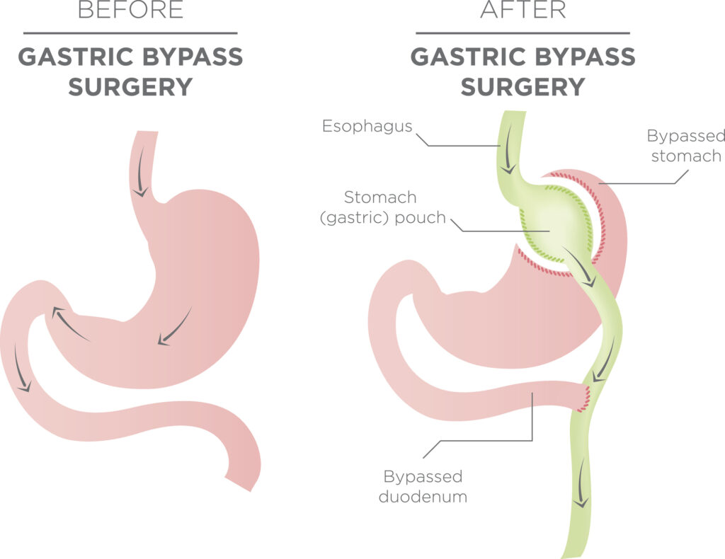 gastric bypass for weight loss